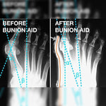 BUNION CORRECTOR (1PAIR)
