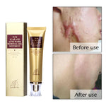 Acne Scar Cream ( New version )